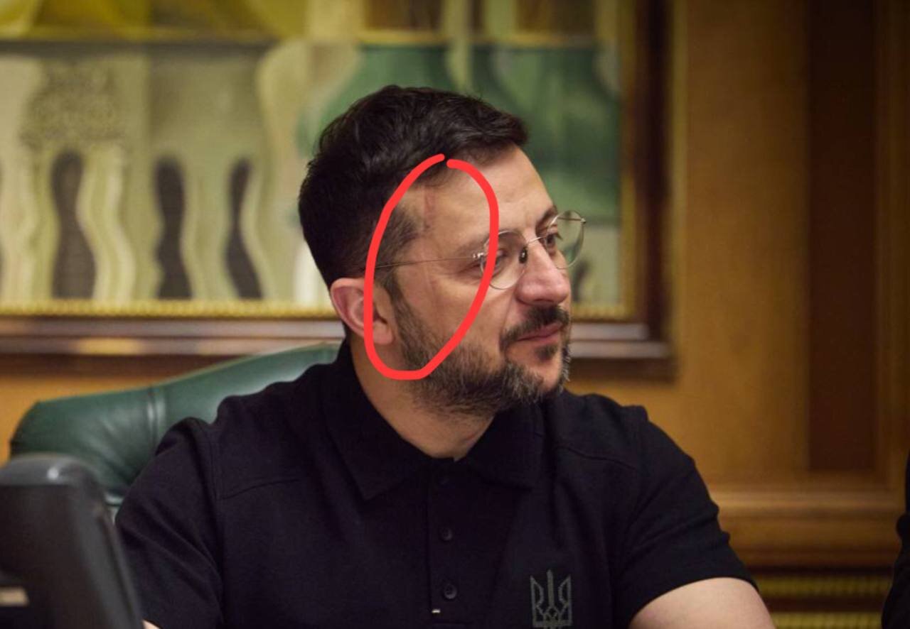 Zelenskinin üzünə nə olub?