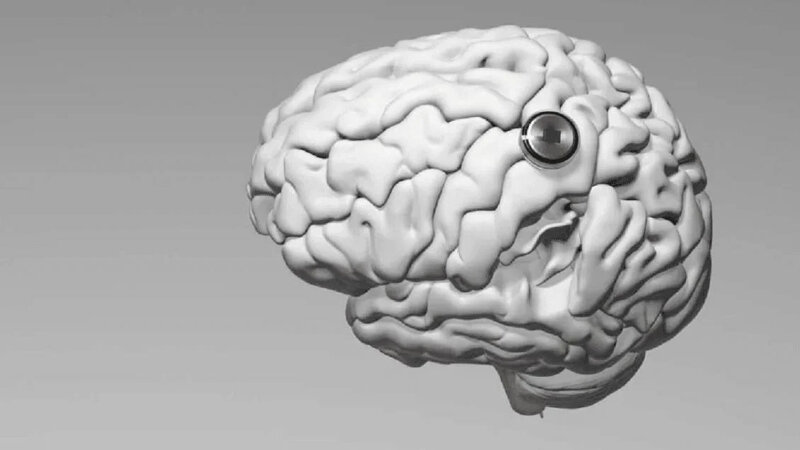 Çin insan beyninə implant yerləşdirdi: Artıq düşüncə ilə videooyun oynayır