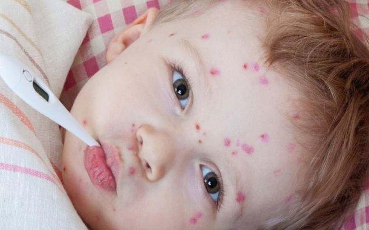 Ötən il qızılca və suçiçəyinə yoluxanların sayı açıqlandı