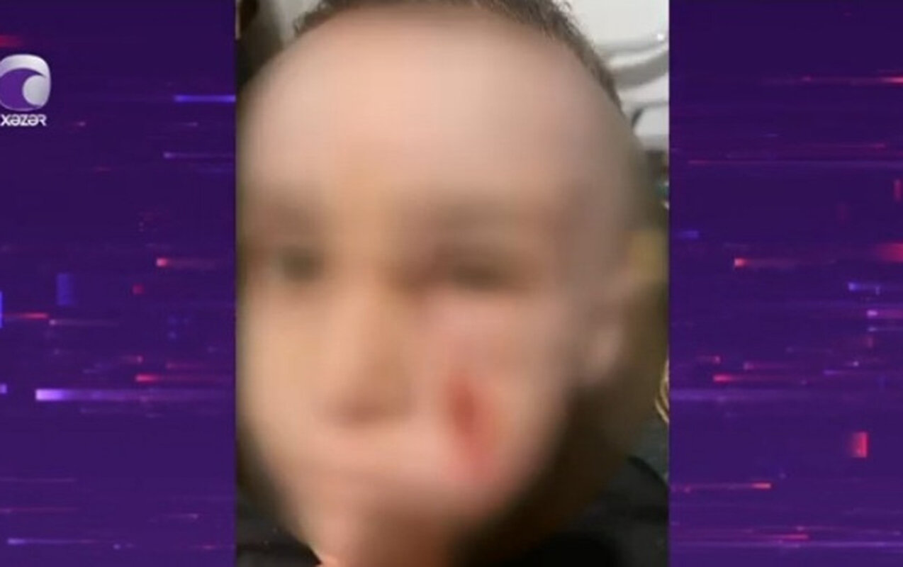 Bakıda bağçada uşaq xəsarət alıb, təcili yardım çağırılmayıb - Video