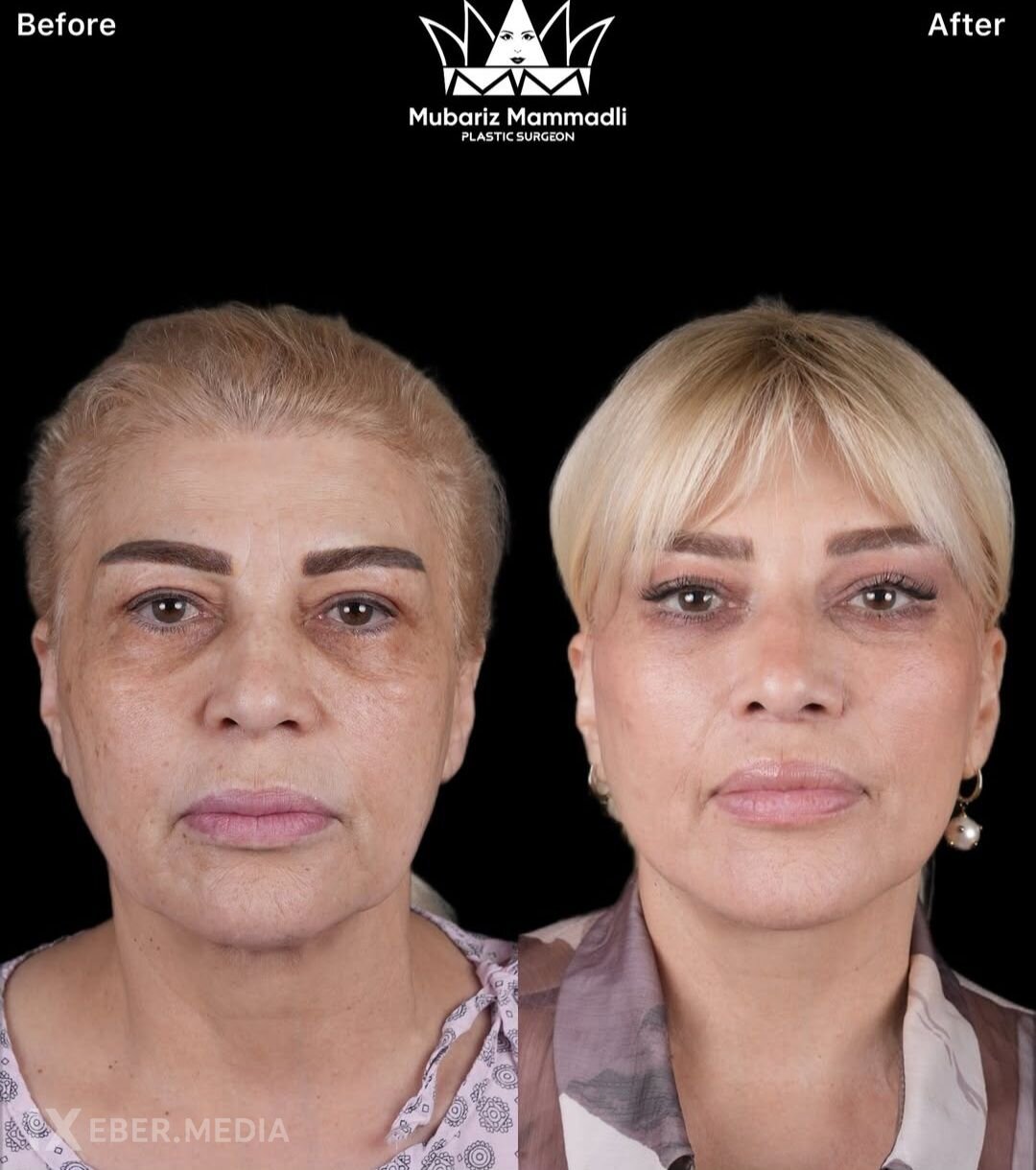 Müğənninin dəyişimi gündəm oldu