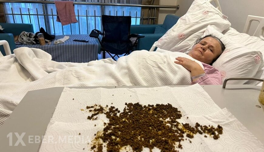 Qarın ağrısından şikayət etdi, ödündən 20 mindən çox daş çıxdı