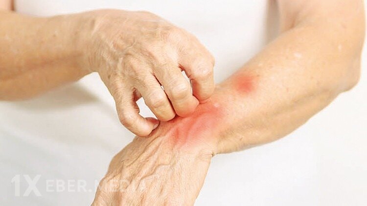 Təhlükəli cüzam PANİKASI - İki ölkədə yayıldı