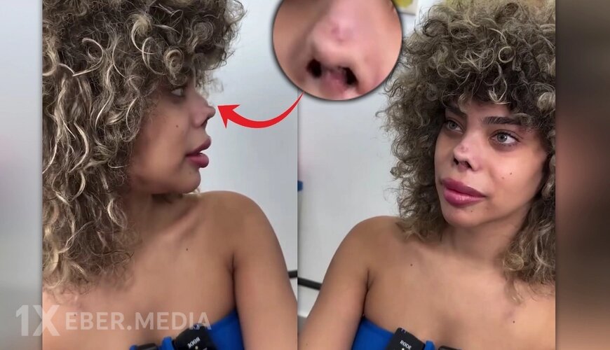 Türkiyədə plastik əməliyyat olunan qadın burnunun yarısını itirdi - VİDEO