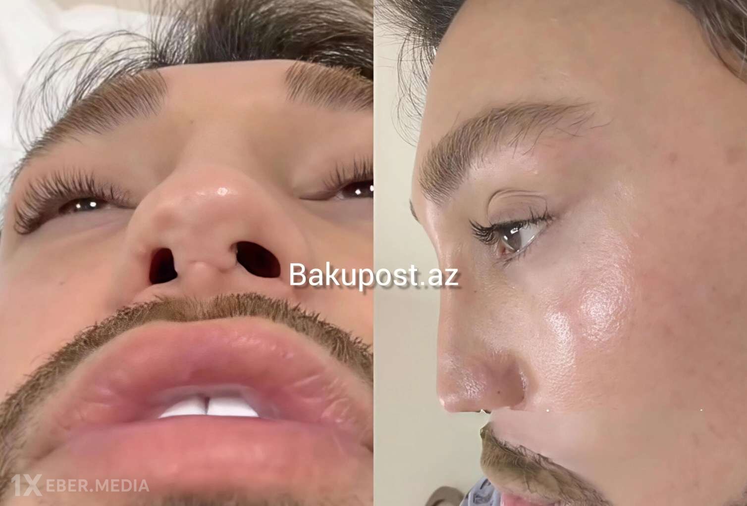 Azərbaycanın ən uğursuz plastik cərrahları: Tanınmış stilist onları İFŞA etdi