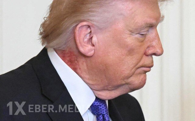 Tramp boynundakı qəribə ləkə ilə gündəmdə