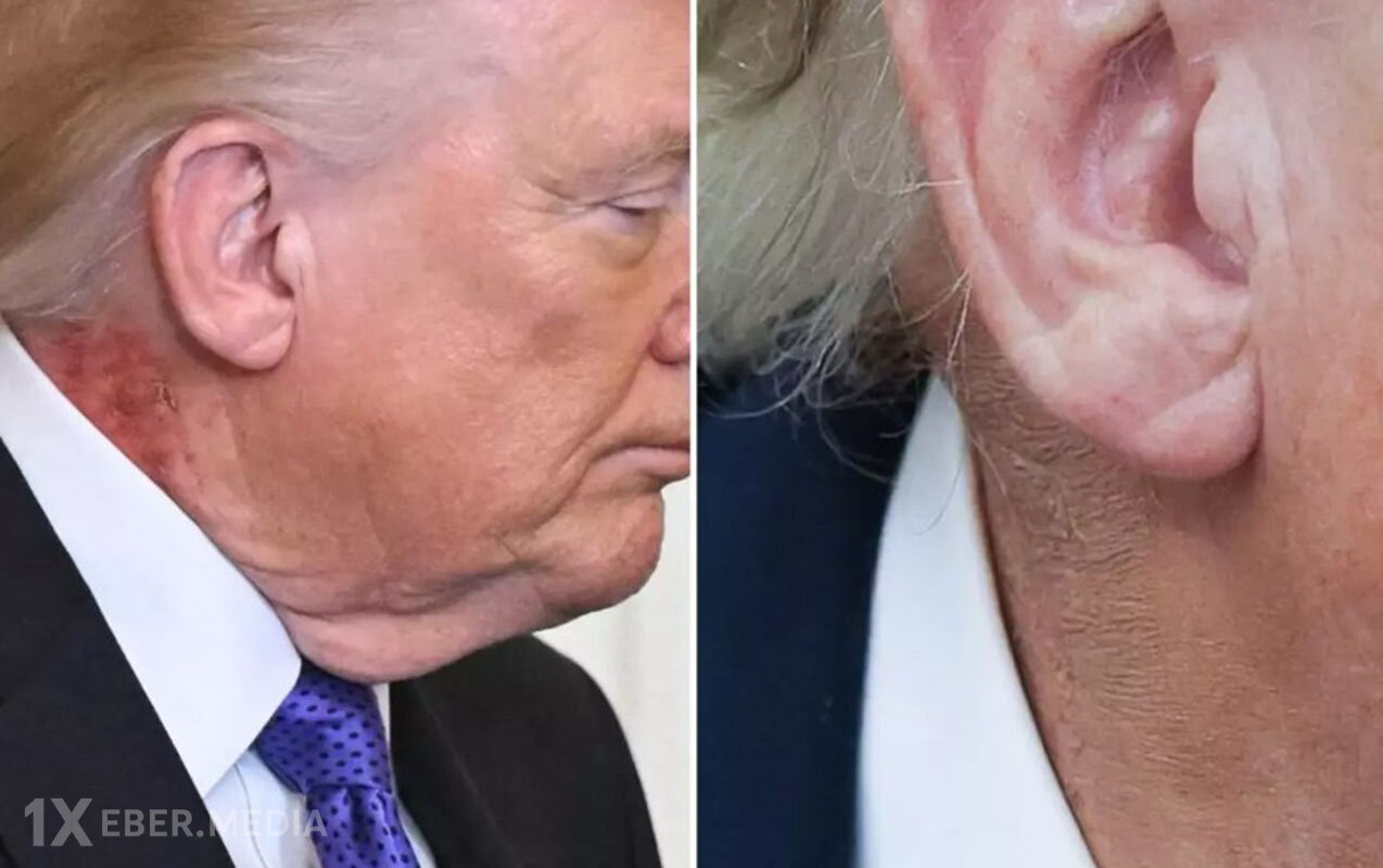 Prezident qızartıları makiyajla gizlətdi