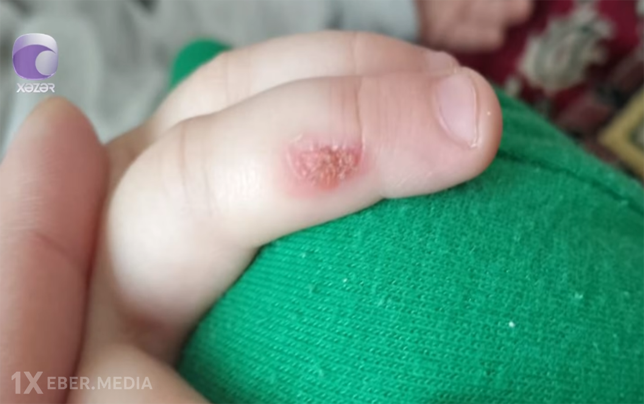 “3 yaşlı uşağım bağçada ağlayanda bıçağı qızdıraraq əlinə basıb” - Video