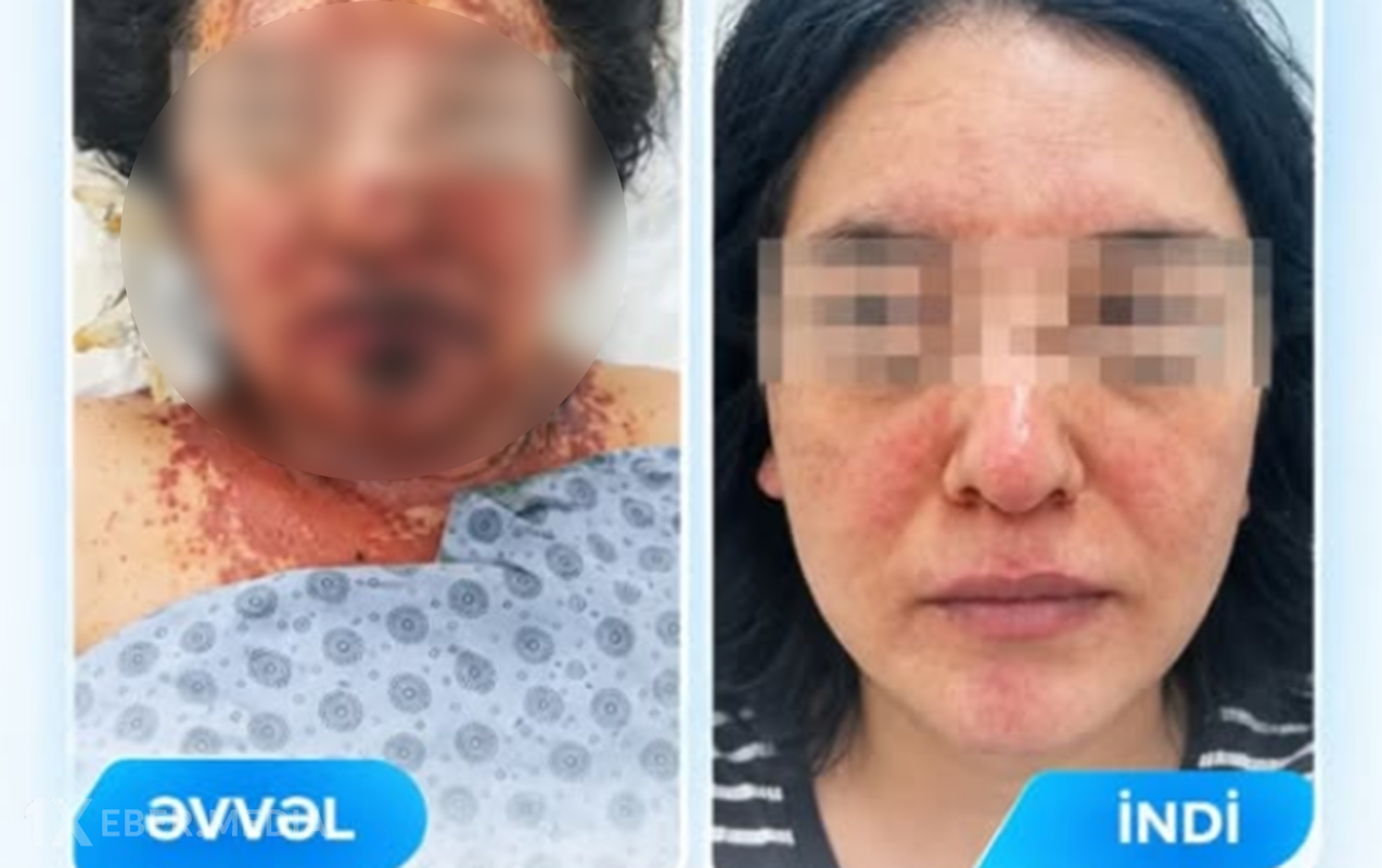 Dərman qəbulundan sonra ağır allergik reaksiya verdi - Foto