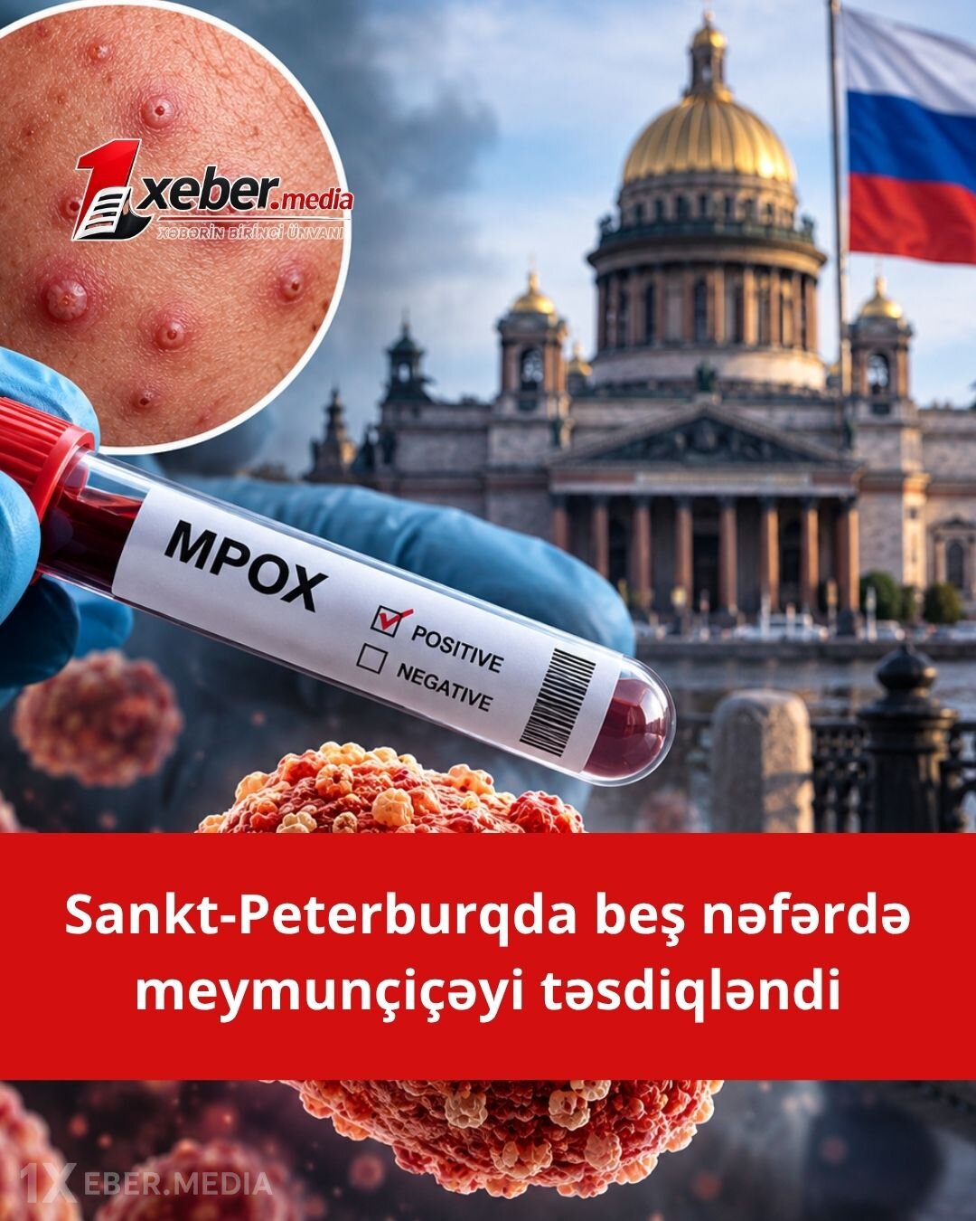 Sankt-Peterburqda dəhşətli virus: 5 nəfərdə meymunçiçəyi aşkarlandı